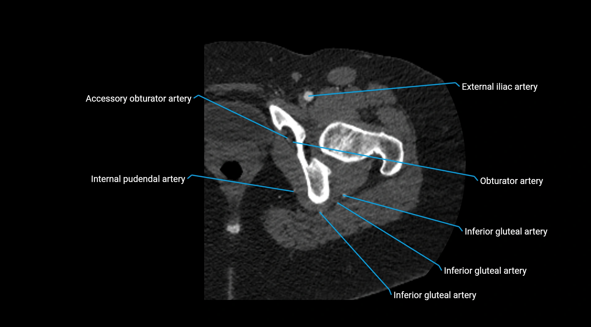 CTA lower limb cross sectional anatomy labelled image _60.webp